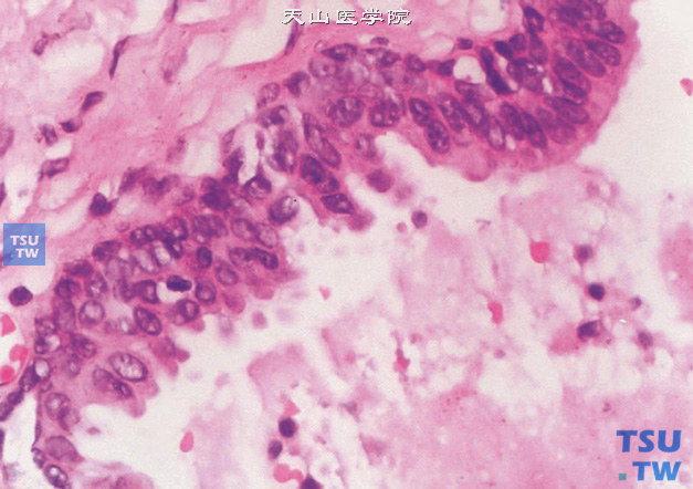 前列腺高级别PIN，扁平型。分泌层细胞拥挤，腔面细胞可见顶浆分泌