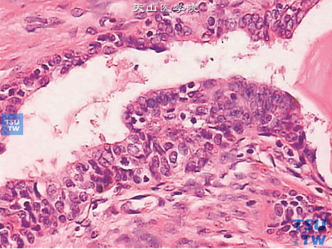 前列腺高级别PIN，蕈型。细胞核及核仁增大，核仁可为单个或多个，可见核重叠