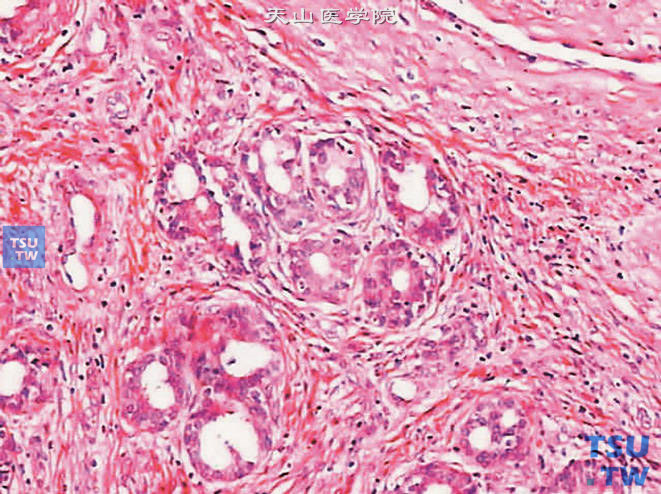 前列腺非典型腺瘤样增生，为小叶内腺体增生