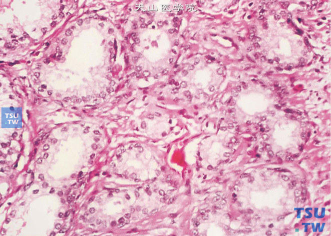 前列腺非典型腺瘤样增生，部分细胞核中有小核仁