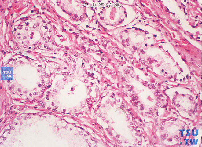 前列腺非典型腺瘤样增生，部分腺体周围有基底细胞