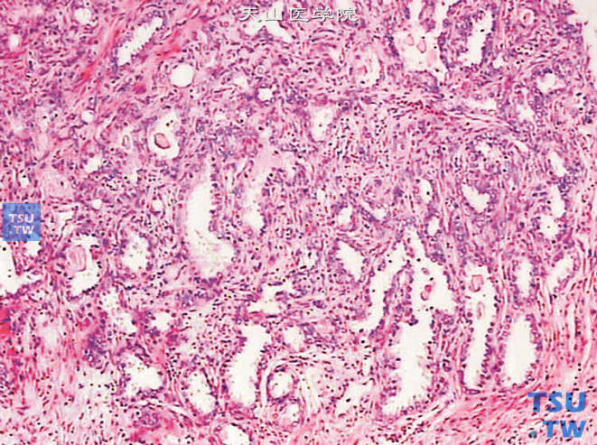 前列腺非典型腺瘤样增生，示病灶内有长形的腺体，还有些由分化好的腺上皮细胞构成的具有分支状腺腔的腺体