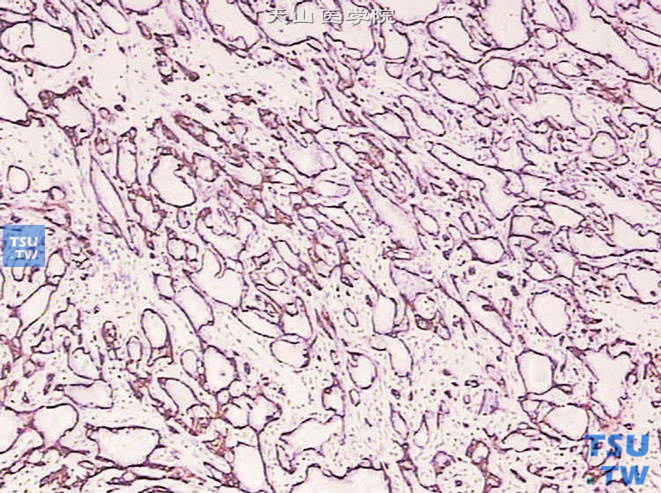 前列腺非典型腺瘤样增生，免疫组化：34βE12 （+）