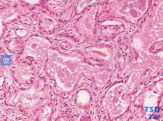 前列腺非典型腺瘤样增生，腺腔内可见结晶（上图高倍）