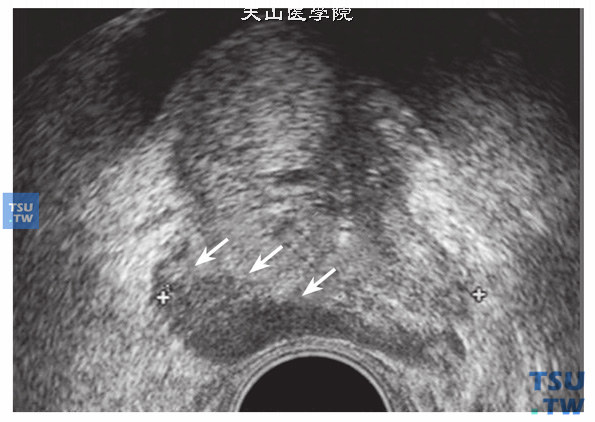 前列腺癌超声图像特点：前列腺癌是老年男性泌尿系肿瘤中较为常见的一种，而超声诊断及前列腺穿刺方法简单，具有重要的临床意义。前列腺癌结节主要发生于外周带，超声中在外周带可见大小不等的低回声结节，早期结节局限，发展到晚期病变蔓延，前列腺形态可失常，被膜受侵遭到破坏时，被膜缺损失去连续性。而前列腺癌多发生于高龄人，这些病人多半在患前列腺增生的基础上癌变（箭头指示外周带低回声癌结节）