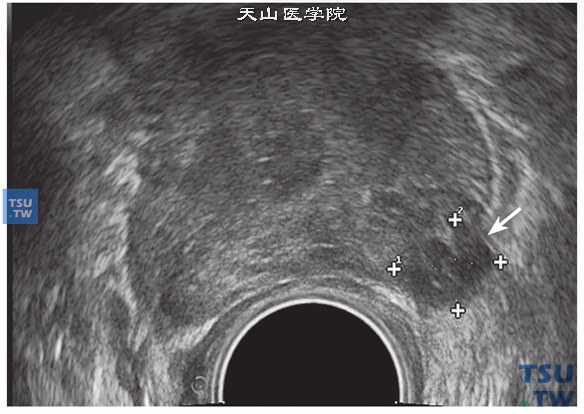 前列腺癌超声图像特点：前列腺低回声癌结节局限在左叶外周带，但前列腺被膜已有破坏