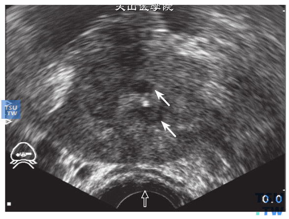 前列腺癌超声图像特点：前列腺癌较晚期，前列腺内散在多发低回声结节，边缘不整齐，回声不均质，前列腺被膜连续性中断，被膜破坏明显