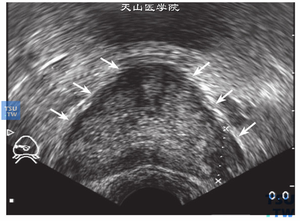 前列腺癌超声图像特点：前列腺外周带弥漫性低回声改变，被膜粗糙不平，前列腺被膜完全破坏性改变