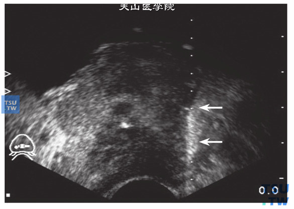 前列腺癌超声引导下前列腺穿刺活检超声图像特点：前列腺癌侵犯双侧精囊腺及膀胱颈部。前列腺穿刺活检术（箭头指示：活检针穿过低回声结节）。病理：前列腺癌侵犯精囊腺