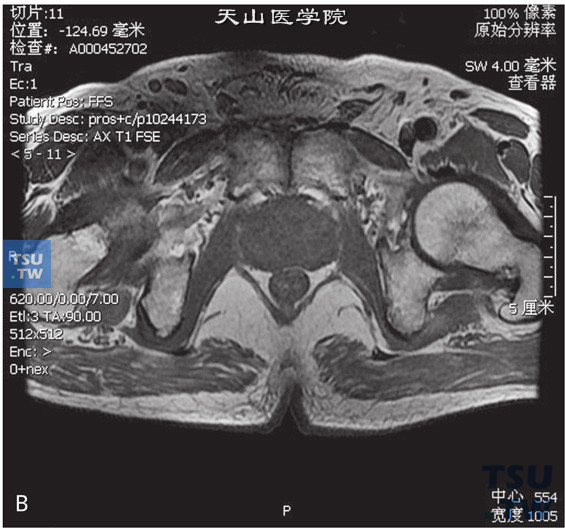 图B：CT，前列腺癌男，74岁，体检PSA升高。前列腺右侧外周带见片状T2WI低信号T1WI等信号灶，DWI呈高信号。病灶的动态增强曲线为流出型，正常前列腺外周带动态增强曲线为流入型