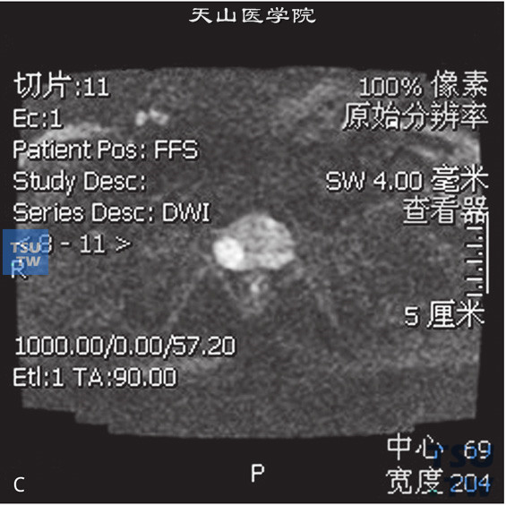 图C：CT，前列腺癌男，74岁，体检PSA升高。前列腺右侧外周带见片状T2WI低信号T1WI等信号灶，DWI呈高信号。病灶的动态增强曲线为流出型，正常前列腺外周带动态增强曲线为流入型