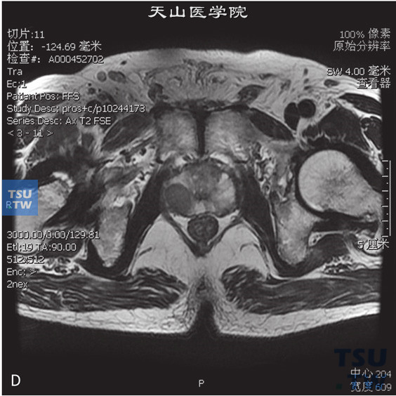 图D：CT，前列腺癌男，74岁，体检PSA升高。前列腺右侧外周带见片状T2WI低信号T1WI等信号灶，DWI呈高信号。病灶的动态增强曲线为流出型，正常前列腺外周带动态增强曲线为流入型