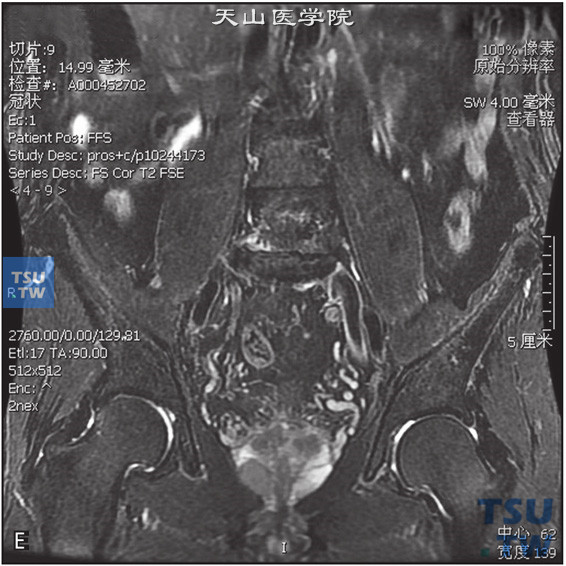 图E：CT，前列腺癌男，74岁，体检PSA升高。前列腺右侧外周带见片状T2WI低信号T1WI等信号灶，DWI呈高信号。病灶的动态增强曲线为流出型，正常前列腺外周带动态增强曲线为流入型