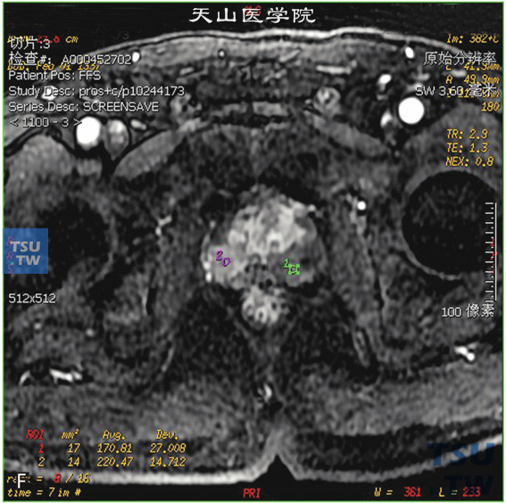 图D：CT，前列腺癌男，74岁，体检PSA升高。前列腺右侧外周带见片状T2WI低信号T1WI等信号灶，DWI呈高信号。病灶的动态增强曲线为流出型，正常前列腺外周带动态增强曲线为流入型