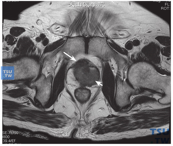 前列腺癌的影像学特征