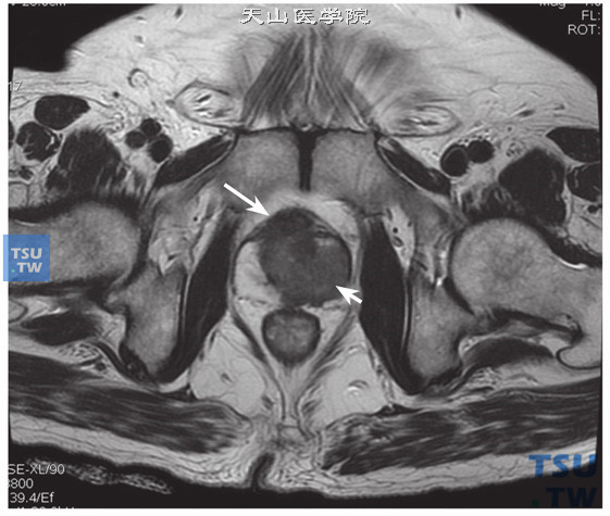 核磁-男，73岁，前列腺癌伴淋巴结转移，T2WI，中央区、左侧外周带稍低信号占位（短箭），右前方包膜外凸改变（长箭）