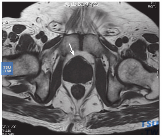 核磁-男，73岁，前列腺癌伴淋巴结转移，T1WI，肿块呈等信号，包膜外凸改变显示清晰
