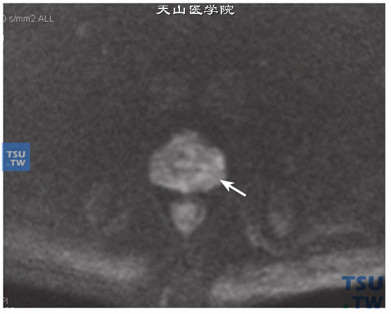 核磁-男，73岁，前列腺癌伴淋巴结转移，DWI，肿块呈稍高信号
