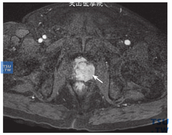 核磁-男，73岁，前列腺癌伴淋巴结转移，增强，肿块明显强化
