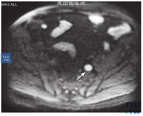 核磁-男，73岁，前列腺癌伴淋巴结转移，DWI，肿大淋巴结呈高信号