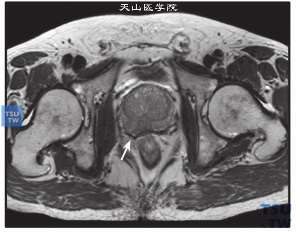 核磁-男，72岁，前列腺癌侵犯包膜，T2WI，右侧外周带片状低信号（箭头），局部包膜外凸