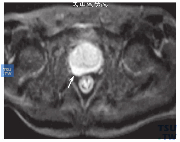 核磁-男，72岁，前列腺癌侵犯包膜，DWI，病灶呈明显高信号，包膜膨突