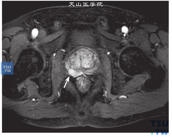 核磁-男，72岁，前列腺癌侵犯包膜，DWI，增强示病灶明显强化