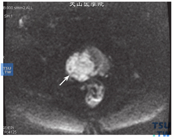 核磁-男，74岁，前列腺癌穿刺后，DWI，肿物呈高信号