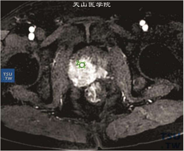 图A：核磁-男穿刺后，动态增强，肿物明显强化，ROI置于肿块内，动态增强曲线为流出型