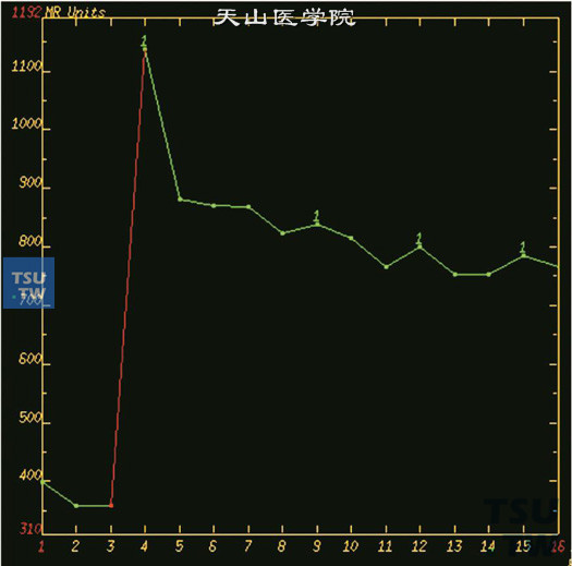 图B：核磁-男，74岁，前列腺癌穿刺后，动态增强，肿物明显强化，ROI置于肿块内，动态增强曲线为流出型