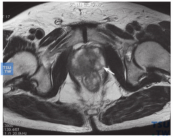 核磁-男，74岁，前列腺癌，穿刺术后T2WI，左侧外周带片状稍低信号