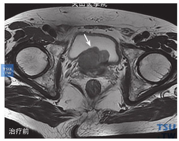 治疗前：核磁-男，74岁，前列腺癌内分泌+放疗治疗前后，治疗前，T2WI，肿块凸向膀胱，侵犯膀胱后壁，治疗后病灶基本消失，局部略显不规则