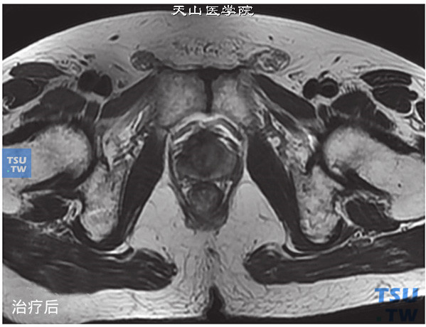 治疗后：核磁-男，74岁，前列腺癌内分泌+放疗治疗前后，治疗前，T2WI，肿块凸向膀胱，侵犯膀胱后壁，治疗后病灶基本消失，局部略显不规则