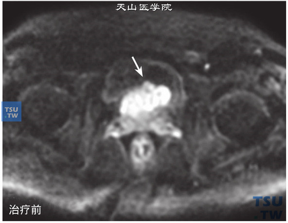 治疗前：核磁-男，74岁，前列腺癌内分泌+放疗治疗前后，治疗前，DWI，肿块呈高信号，治疗后未见明确异常高信号