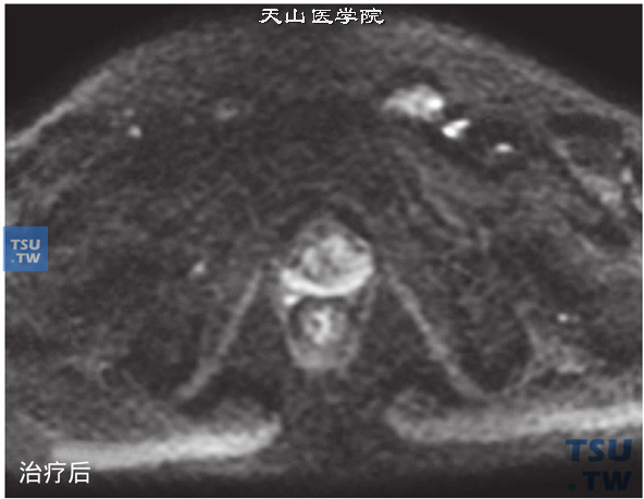 治疗后：核磁-男，74岁，前列腺癌内分泌+放疗治疗前后，治疗前，DWI，肿块呈高信号，治疗后未见明确异常高信号