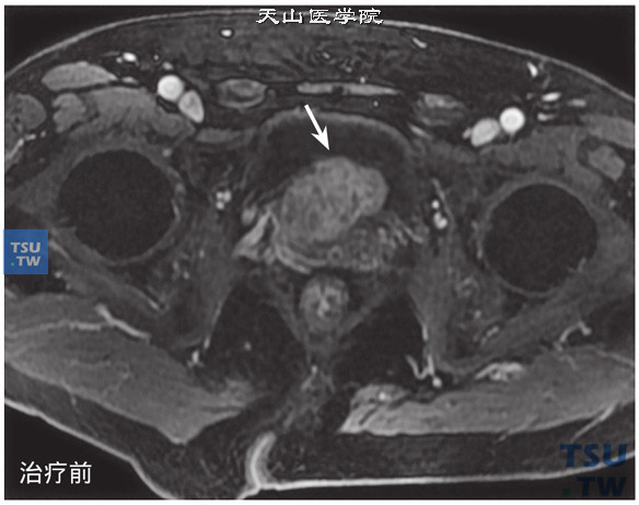 治疗前：核磁-男，74岁，前列腺癌内分泌+放疗治疗前后，治疗前，增强，肿块可见强化，治疗后原异常强化肿块基本消失