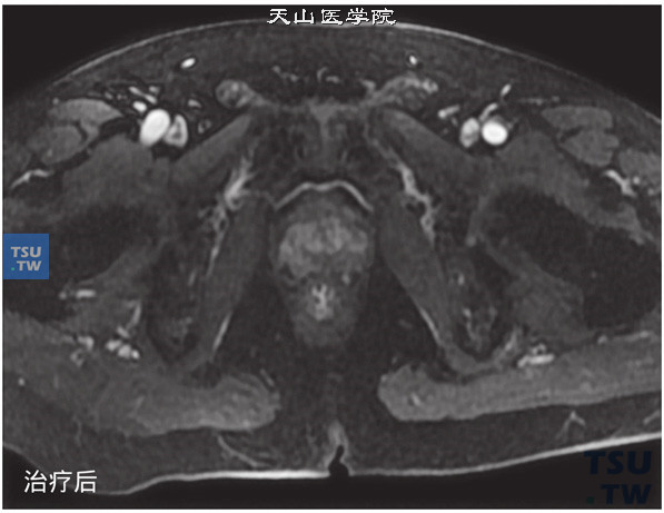 治疗后：核磁-男，74岁，前列腺癌内分泌+放疗治疗前后，治疗前，增强，肿块可见强化，治疗后原异常强化肿块基本消失