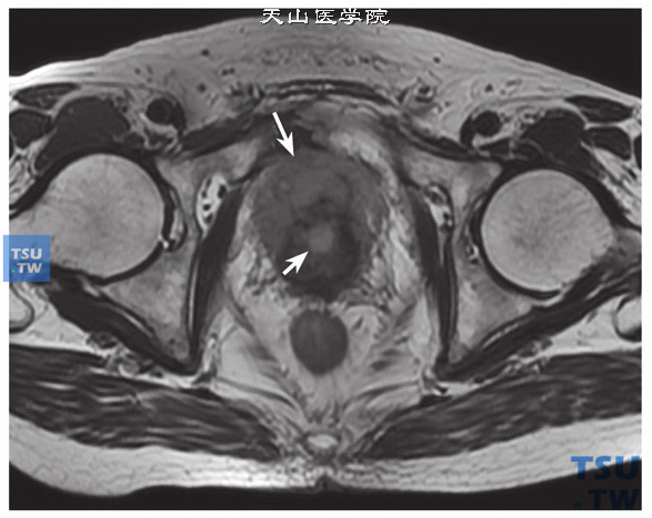 核磁-男，79岁，前列腺癌电切术后，T2WI，术后尿道周围前列腺高信号