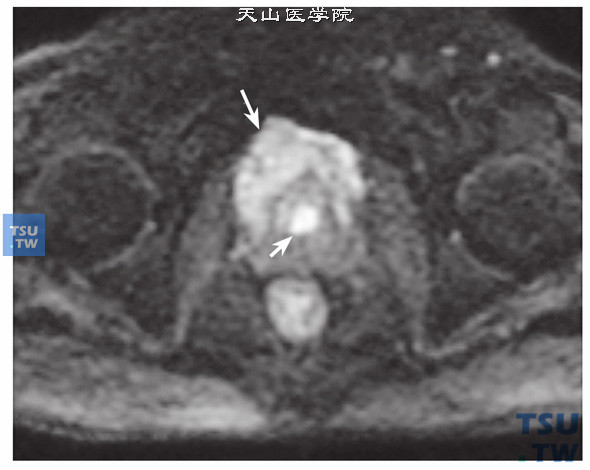 核磁-男，79岁，前列腺癌电切术后，DWI，病变呈高信号