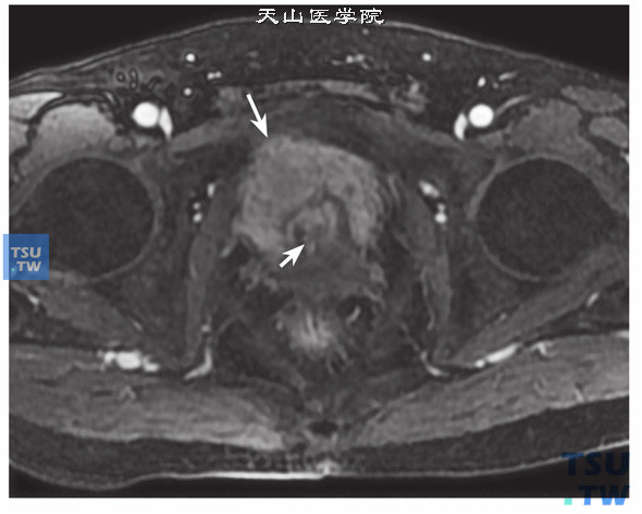 核磁-男，79岁，前列腺癌电切术后，增强，可见强化