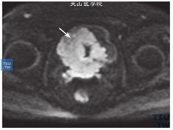 核磁-男，79岁，前列腺癌电切术后，DWI，病变呈明显高信号