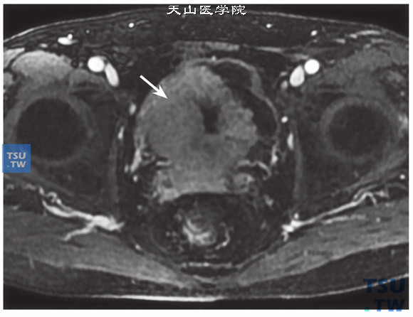 核磁-男，79岁，前列腺癌电切术后，增强，病变明显强化