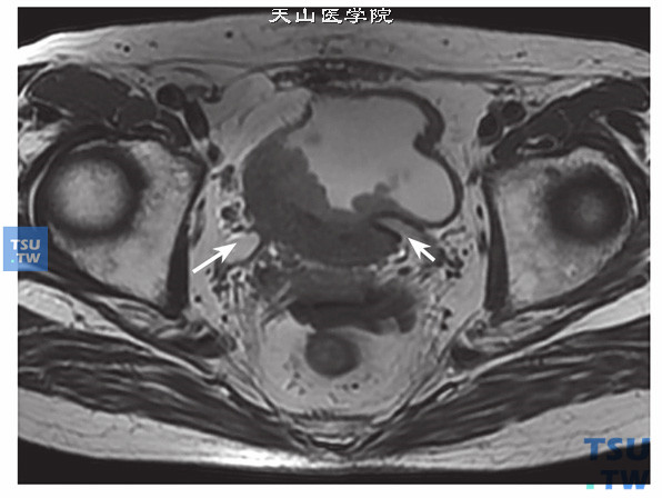 核磁-男，79岁，前列腺癌电切术后，T2WI，病变累及双侧输尿管末端，输尿管扩张，呈高信号
