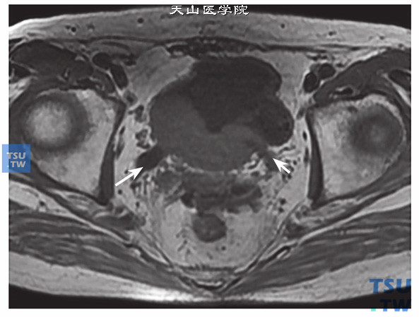核磁-男，79岁，前列腺癌电切术后，T1WI，双侧输尿管扩张，呈低信号