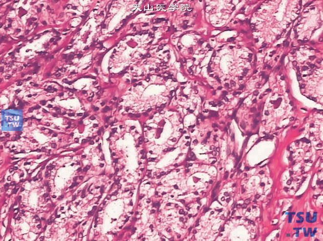 前列腺腺癌的形态学特点，癌组织呈腺泡状结构，腔内结晶体
