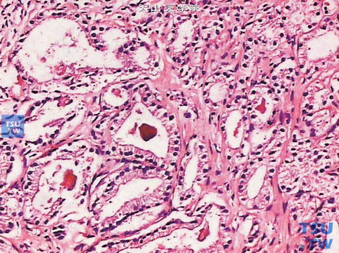 前列腺腺癌的形态学特点，肿瘤由大小不一的腺泡构成