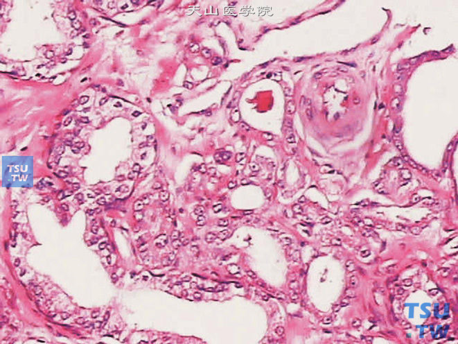 前列腺腺癌的形态学特点，示腺泡腔内类晶体