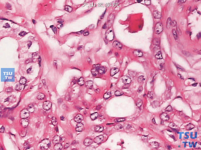 前列腺腺癌的形态学特点，示腺泡腔内类晶体（上图高倍）