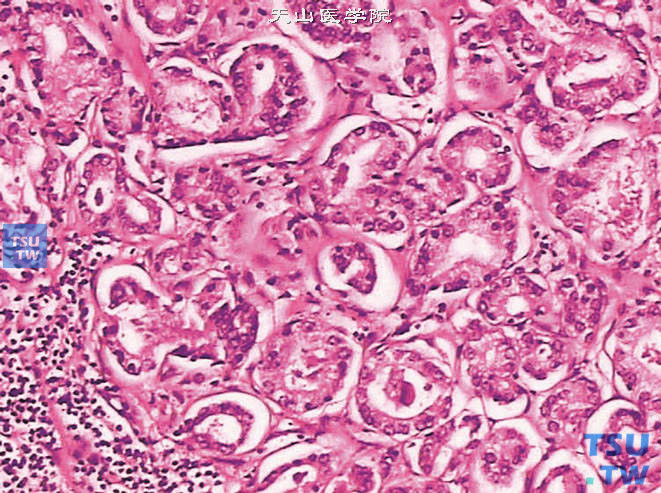 前列腺腺癌的形态学特点，癌组织呈腺泡状结构，可见嗜双染胞质，核增大，核仁明显