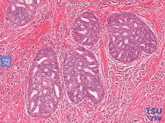 前列腺腺癌的形态学特点，示筛状结构